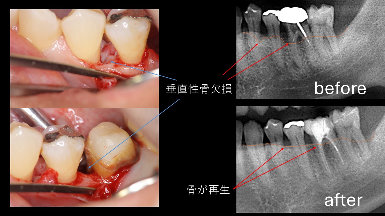 保険治療による歯周組織再生療法　